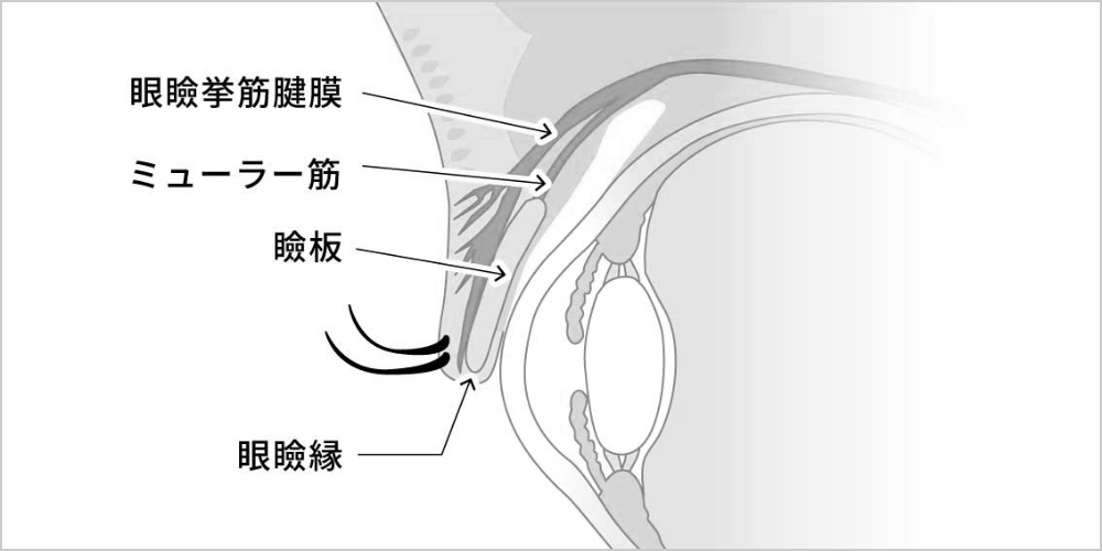 眼瞼挙筋前転術（代表的な手術方法